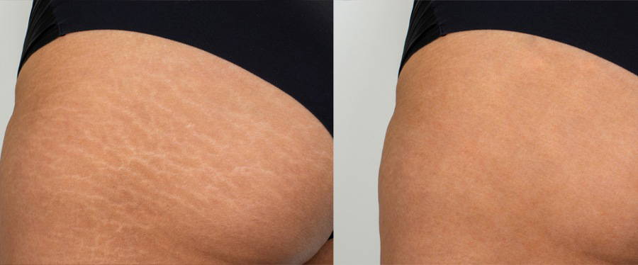 does glutathione help with stretch marks Microneedling Treatment for Stretch Marks main image 1