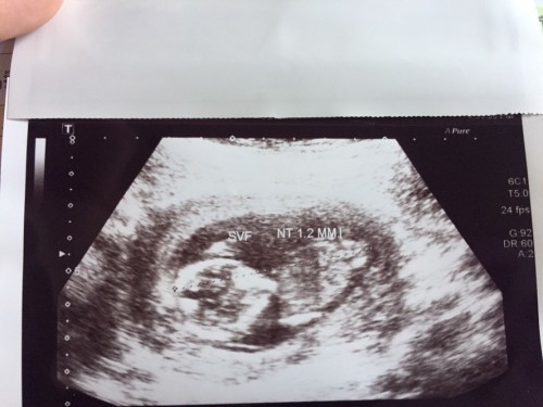 18 wks แล้วลูก ขอให้หนูแข็งแรงนะ