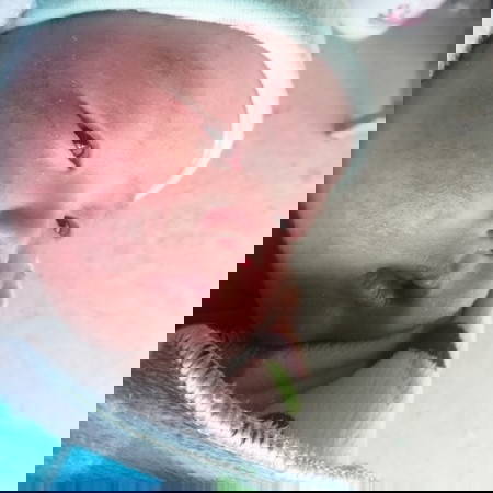 ภูมิแพ้ผิวหนัง