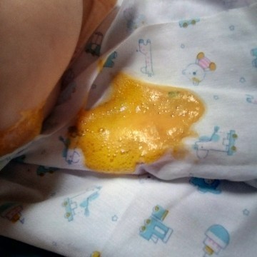 อันตรายไหมถ้าอึลูกเป็นแบบนี้เป็นฟองกินนมแม่ล้วนอายุจะสองเดือนพุ้งนี้ค่ะ