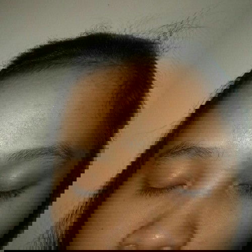 Jerawat saat hamil di trisemester ke dua