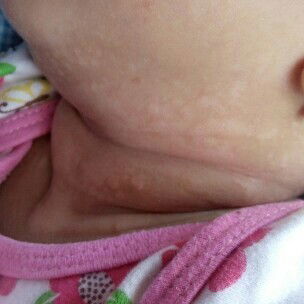 Bercak putih di leher