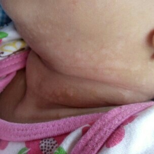 Bercak putih di leher