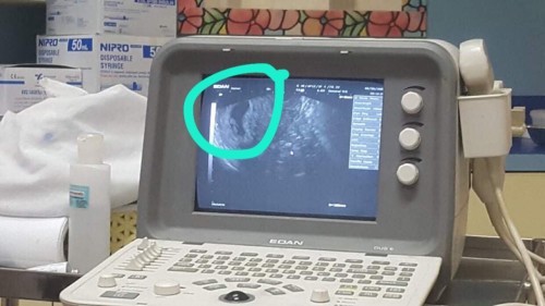 สอบถามคุณแม่ที่สูบบุหรี่คณะตั้งครร์โดยไม่รู้ตัวว่าท้องมาก่อนค่ะ!!!