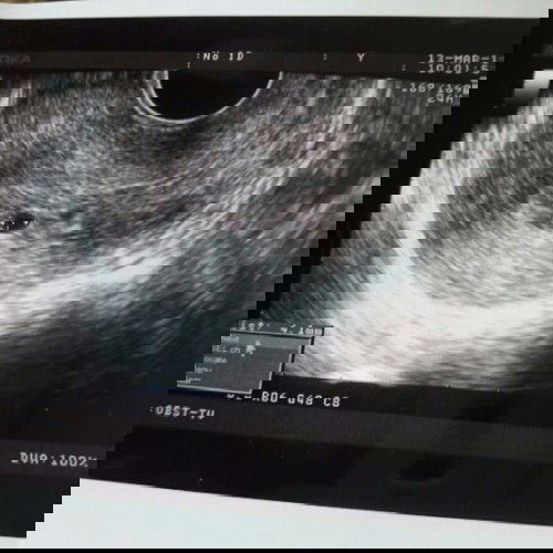 เลือดออกขณะตั้งครรภ์