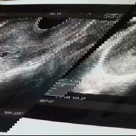 เลือดออกขณะตั้งครรภ์