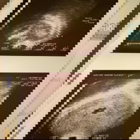 ไปหาหมอเพื่อฝากครรภ์ แต่เจอเนื้องอกในมดลูก