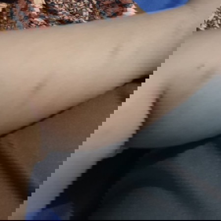 bekas gigitan serangga