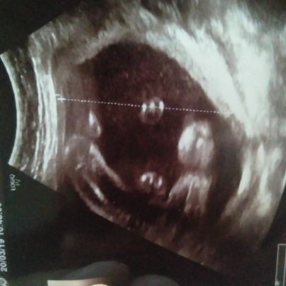 apa ada yg tau ni fto usg kmbar ap ga ya