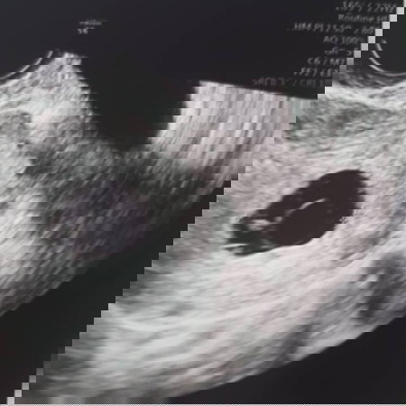 6 สัปดาห์ ไปซาวผ่านช่องคลอด เห็นตัวน้อง แต่คุณหมอบอกไม่มีการเต้นของหัวใจ