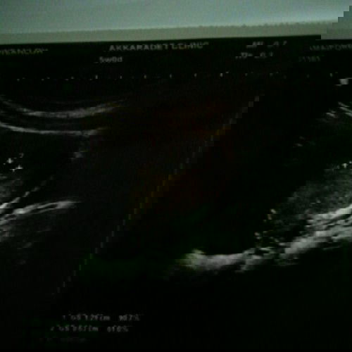 การตั้งครรภ์