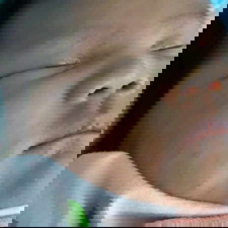 ผดขึ้นหน้า