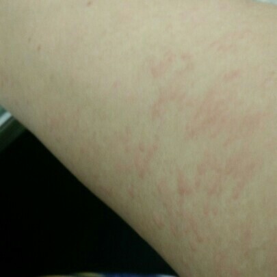 เป็นผื่นระหว่างตั้งครรภ์