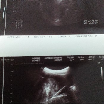 เนื้องอกที่มดลูกและการตั้งครรภ์