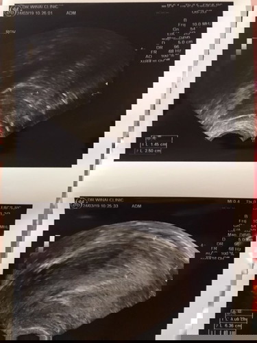 5week ไม่เจอถุงตั้งครรภ์