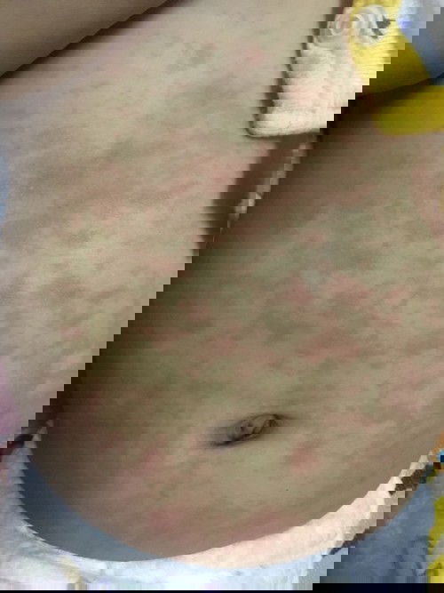 บ้านไหนเคยเป็นส่าไข้ขึ้นเยอะขนาดนี้ไหมคะ?