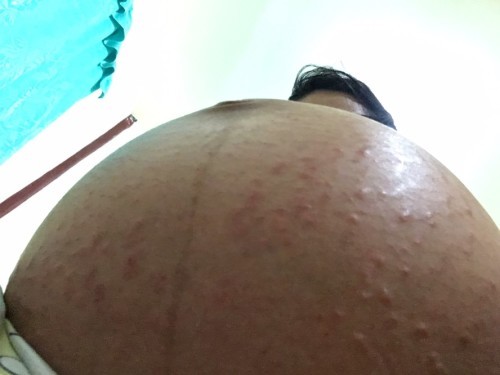 แม่ๆคนไหนเคยเป็นตุ่มผื่นคันที่ท้องบ้างคะ 37week+5 คันมาก ไม่เกาก็ใจจะขาด ตอนแรกคิดว่าเป็นตุ่มแรกเริ่มของท้องแตกลาย แต่ตอนนี้ไม่น่าจะใช่แล้ว พอมาวันนี้เริ่มไม่ไหวแล้วพรุ่งนี้สงสัยต้องไปพบหมอแล้วว