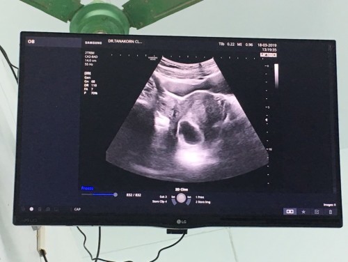 มีใครเคยเป็นท้องลมบ้างคะ