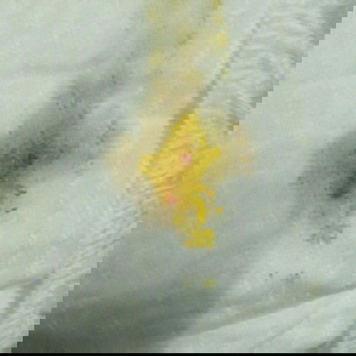 bowel movement with blood.