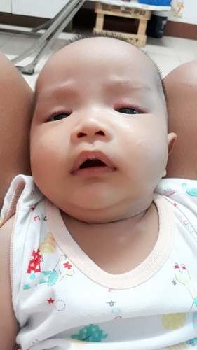 เด็ก 3 เดือนเปลือกตาแดง ลอก ลูกชอบขยี้ตา จะเป็นอะไรมั่ยคะ