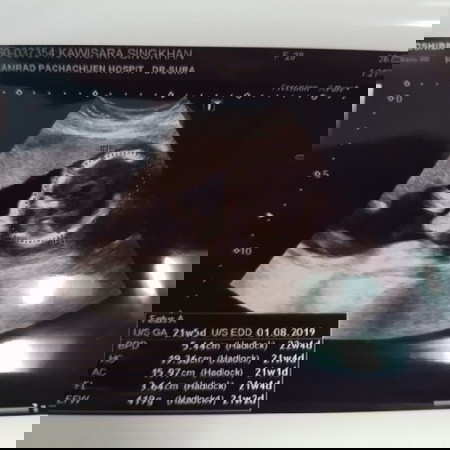 ลูกในครรถ์ 21w 2d ยาว 19.5 นน.419ปกติมั้ยคะ