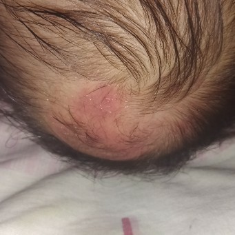 merah merah di kepala