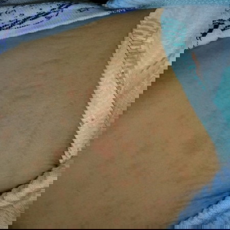 red rashes