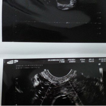 ครรภ์ไม่สมบูรณ์ไม้เห็นหัวใจเด็กเต้น