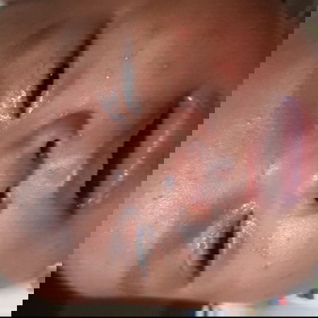 jerawat bayi