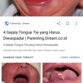 tongue tie