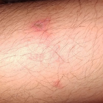 herpes