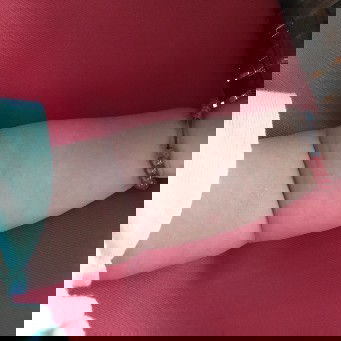 bintik merah ditubuh bcyi