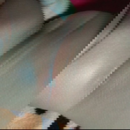 ขาเป็นเเผล