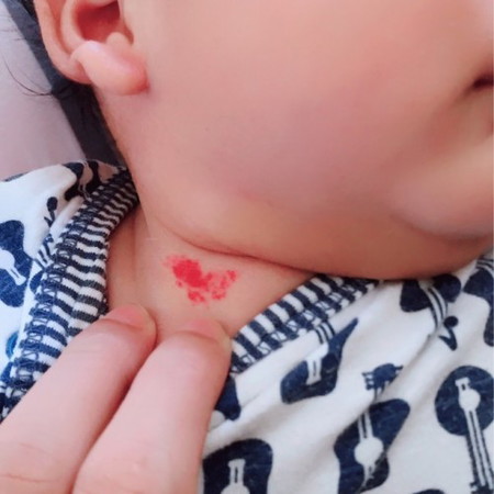 Red mark ( hemangioma)