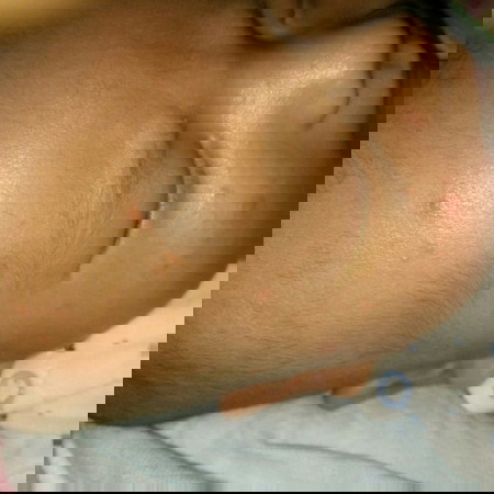 ตุ่มขึ้นหัวขึ้นหน้า