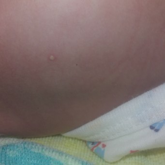 หลังน้องเป็นตุ่มแบบนี้ลบกวนบอกที่ค่ะว่ามันคือตุ่มอะไร