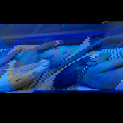 Bagaimana Perkembangan Bayi Yang Terlahir Dengan Sakit Kuning?