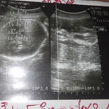 ตั้งครรภ์