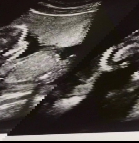 18 weeks