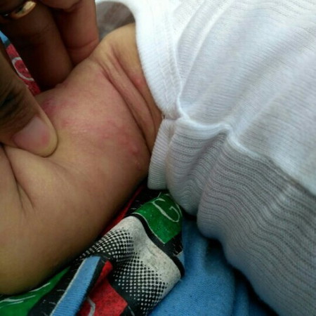 Gatal Gatal Bayi Umur 5bln