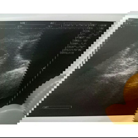 early ultrasound