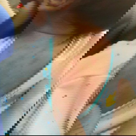 ผื่นแดง