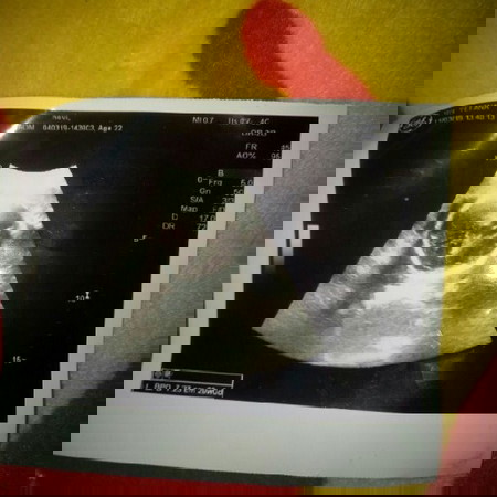 hasil USG