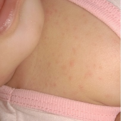 Bungang araw sa baby solution