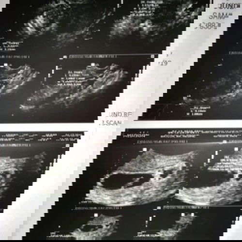 its a twin.base on ultra sound.