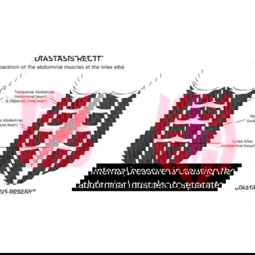 diastasis rekti