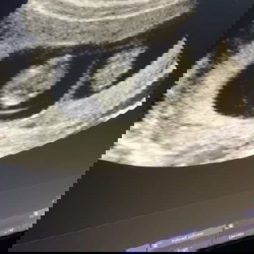 ท้องลูกแฝด สามารถคลอดเองได้มั้ยค่ะ