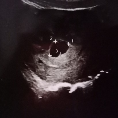 รกผิดปกติ