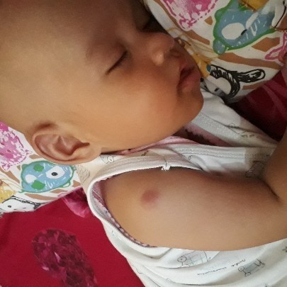 bekas imunisasi