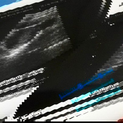 Usg, kandungan sdh membesar tapi janin blm terlihat